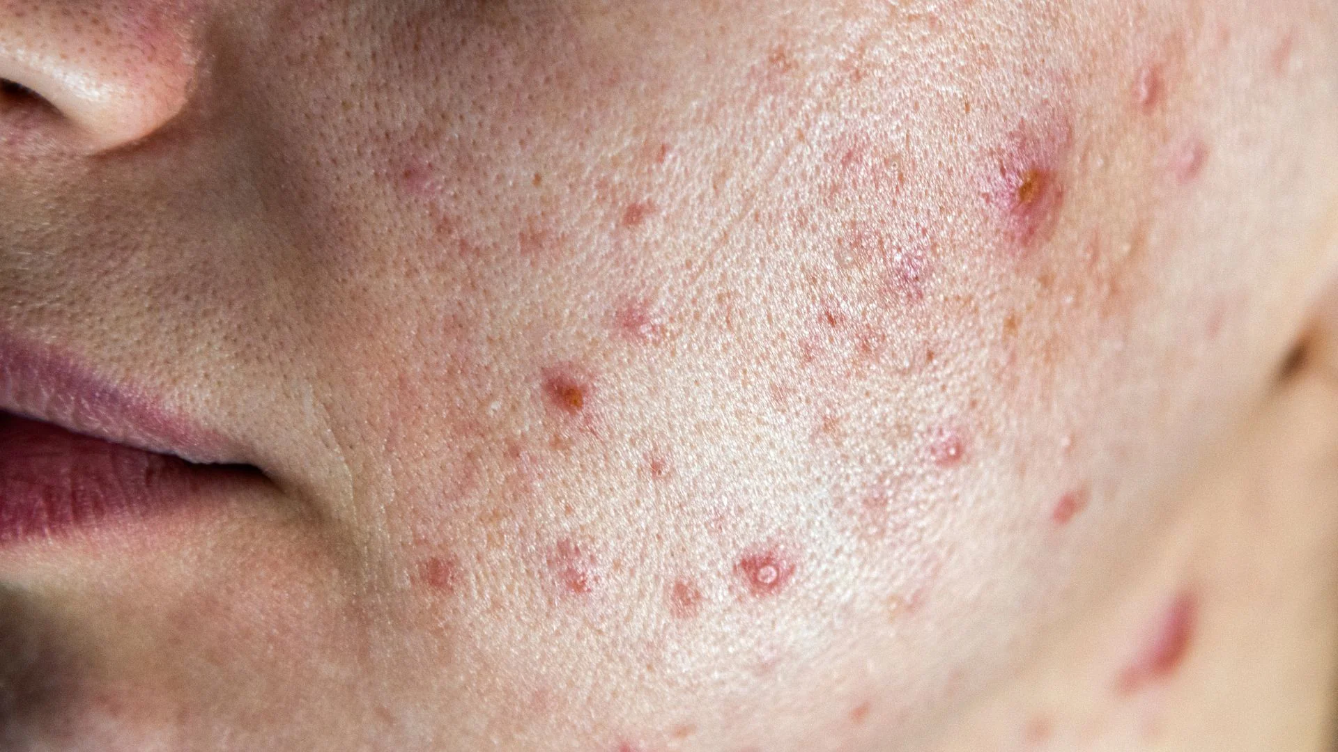 Acne dermatology support