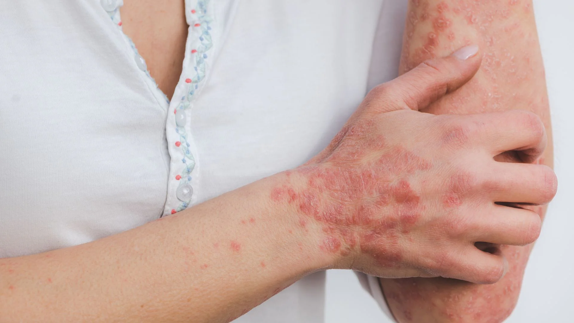 Eczema and psoriasis dermatology support