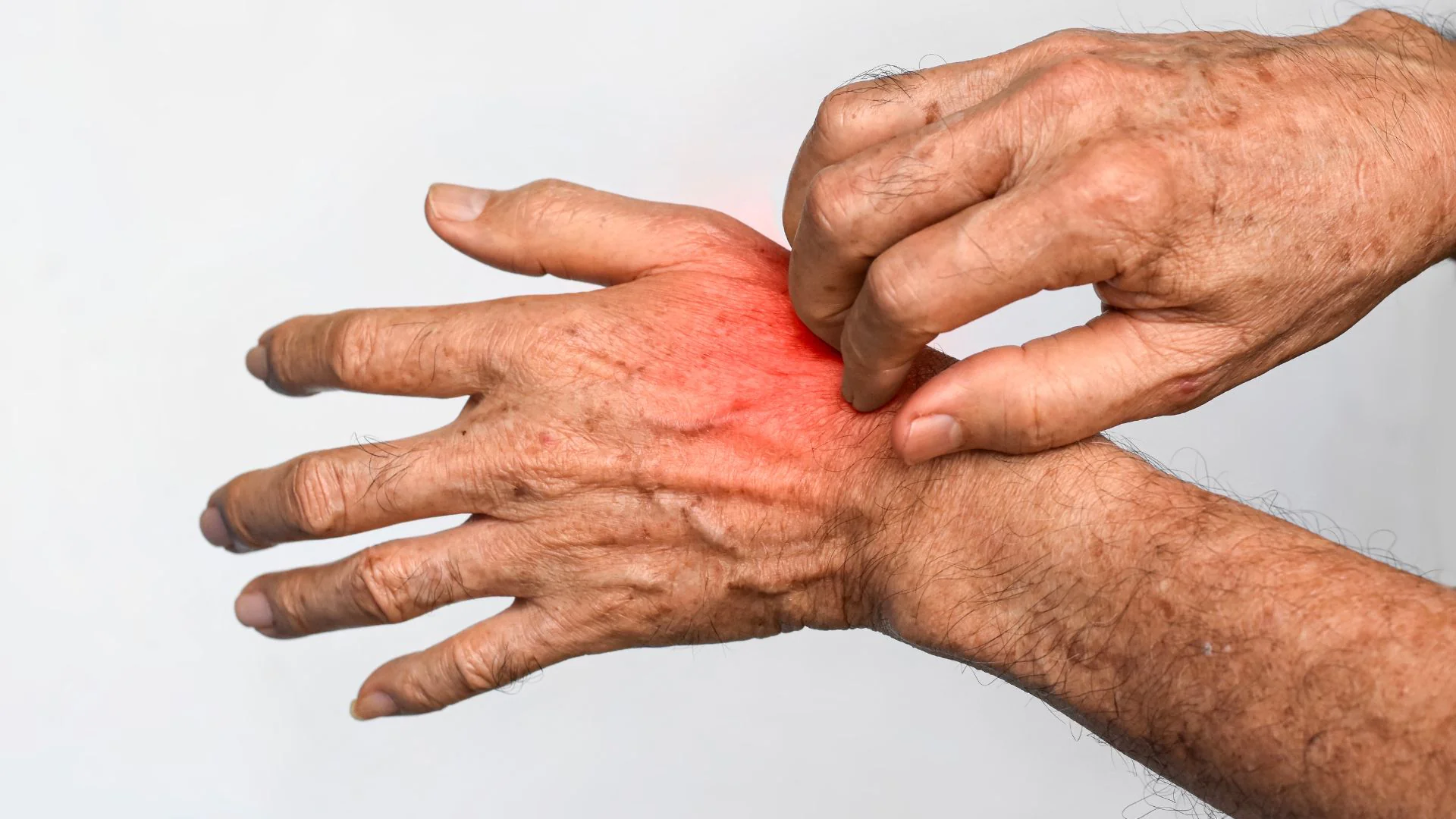 Fungal infection dermatology support
