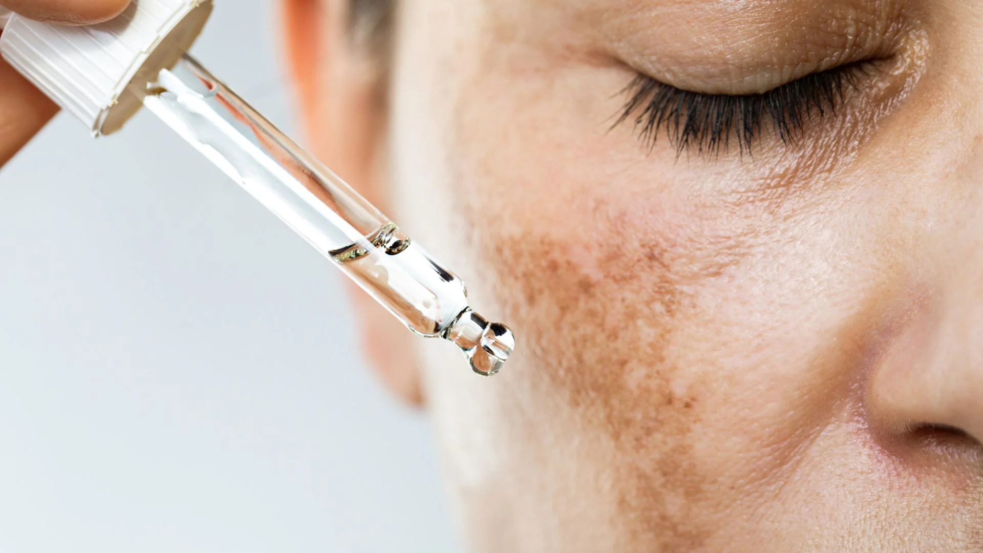 Hyperpigmentation dermatology support