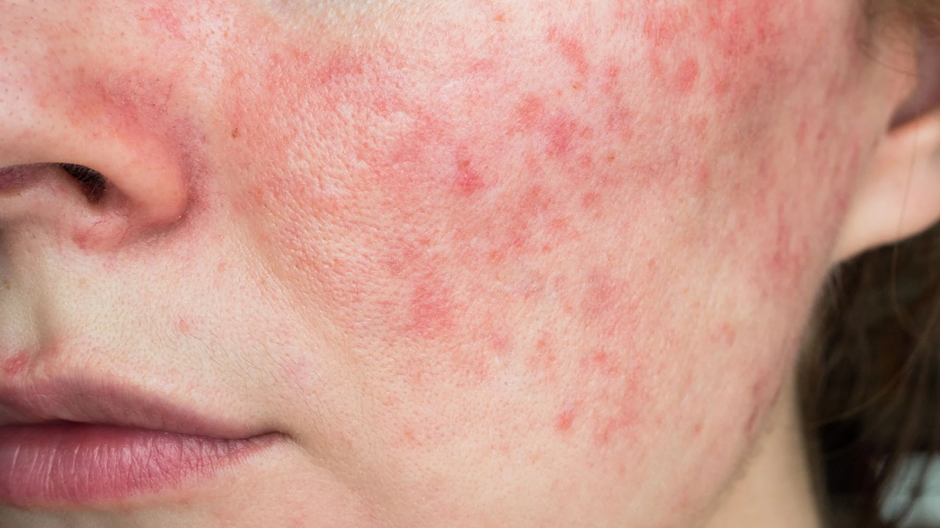 Rosacea dermatology support