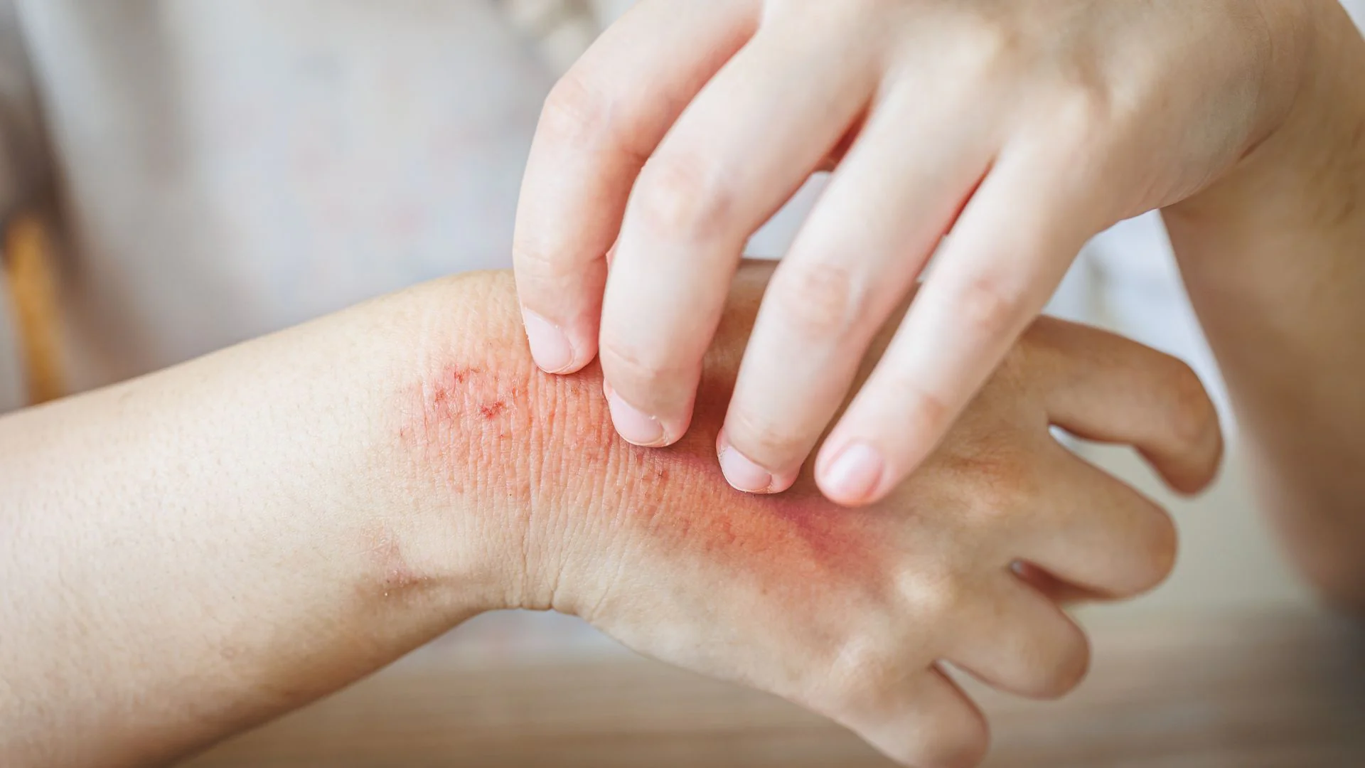Skin allergy dermatology support